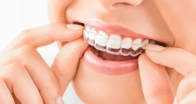 تقويم الأسنان الشفاف لتصحيح الابتسامة دون معدن ظاهر
